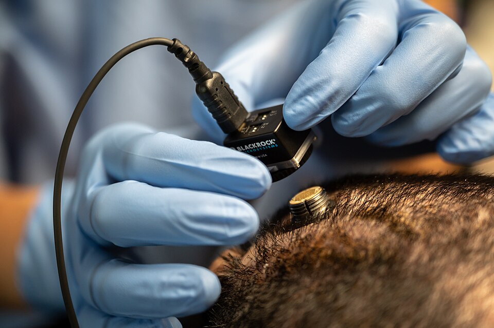 Neuralink implant